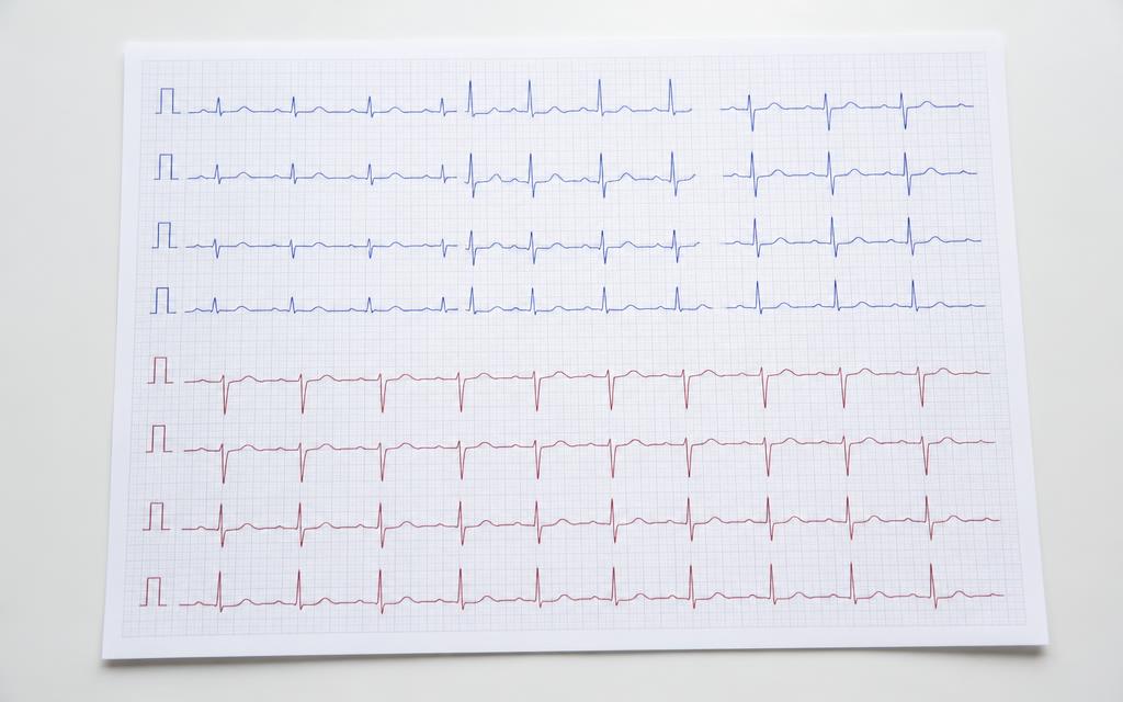 Eletrocardiograma de 12 derivações impresso