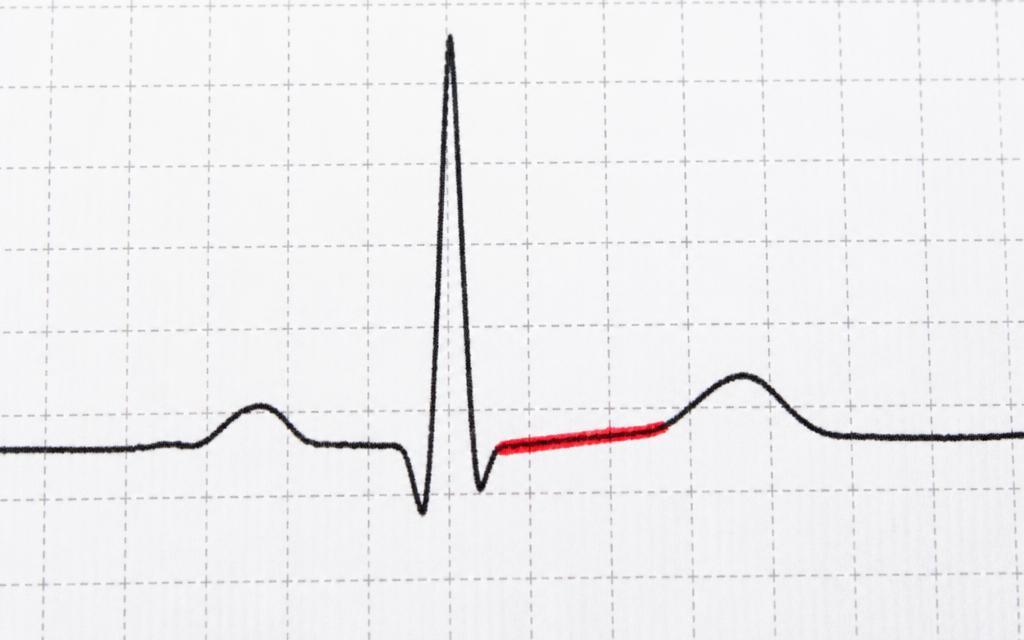 Onda de ECG com segmento ST destacado em vermelho